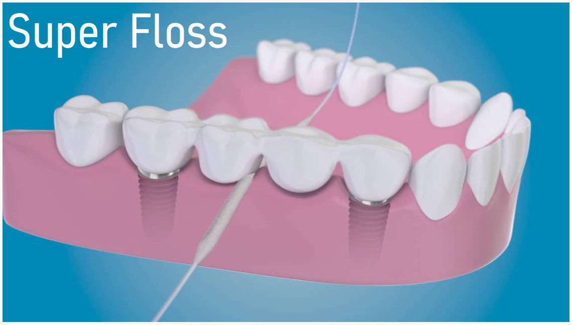 What is the difference between Superfloss, floss threaders, floss